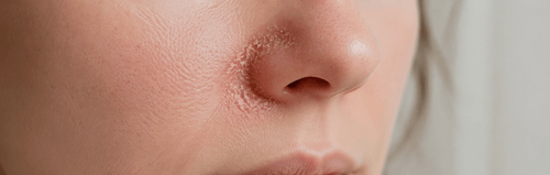How to Treat Fungal Infection & Crusty Dry Skin Around Nose - SkincareEssentials
