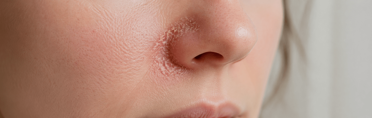 How to Treat Fungal Infection & Crusty Dry Skin Around Nose - SkincareEssentials